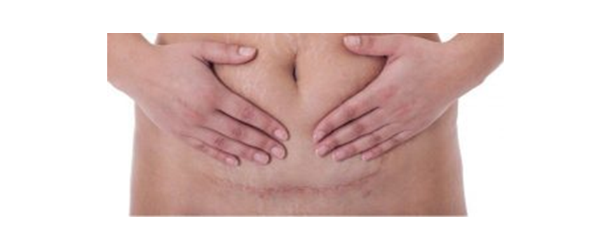 c section recovery